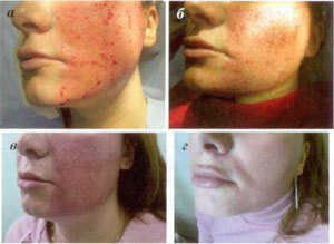 steps of skin restoration after a fractional ablation procedure