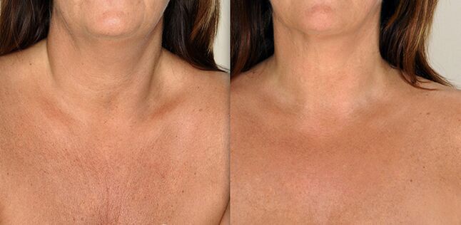 Cleavage area before and after rejuvenation procedures