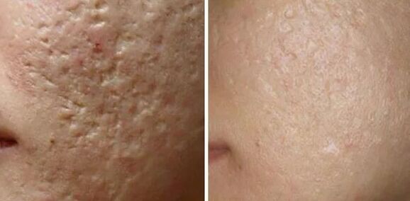 Scars laser grinding