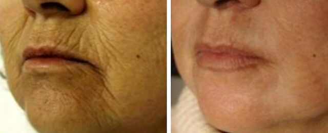4D rejuvenation